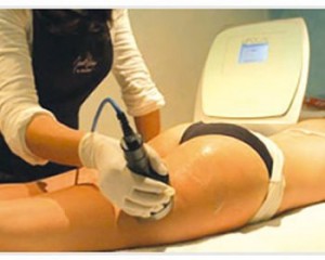 lipocavitation